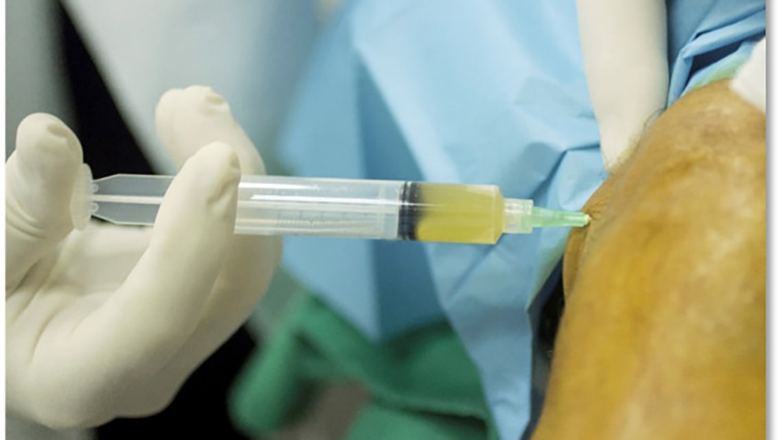 A Simple Guide To Platelet Rich Plasma (PRP)